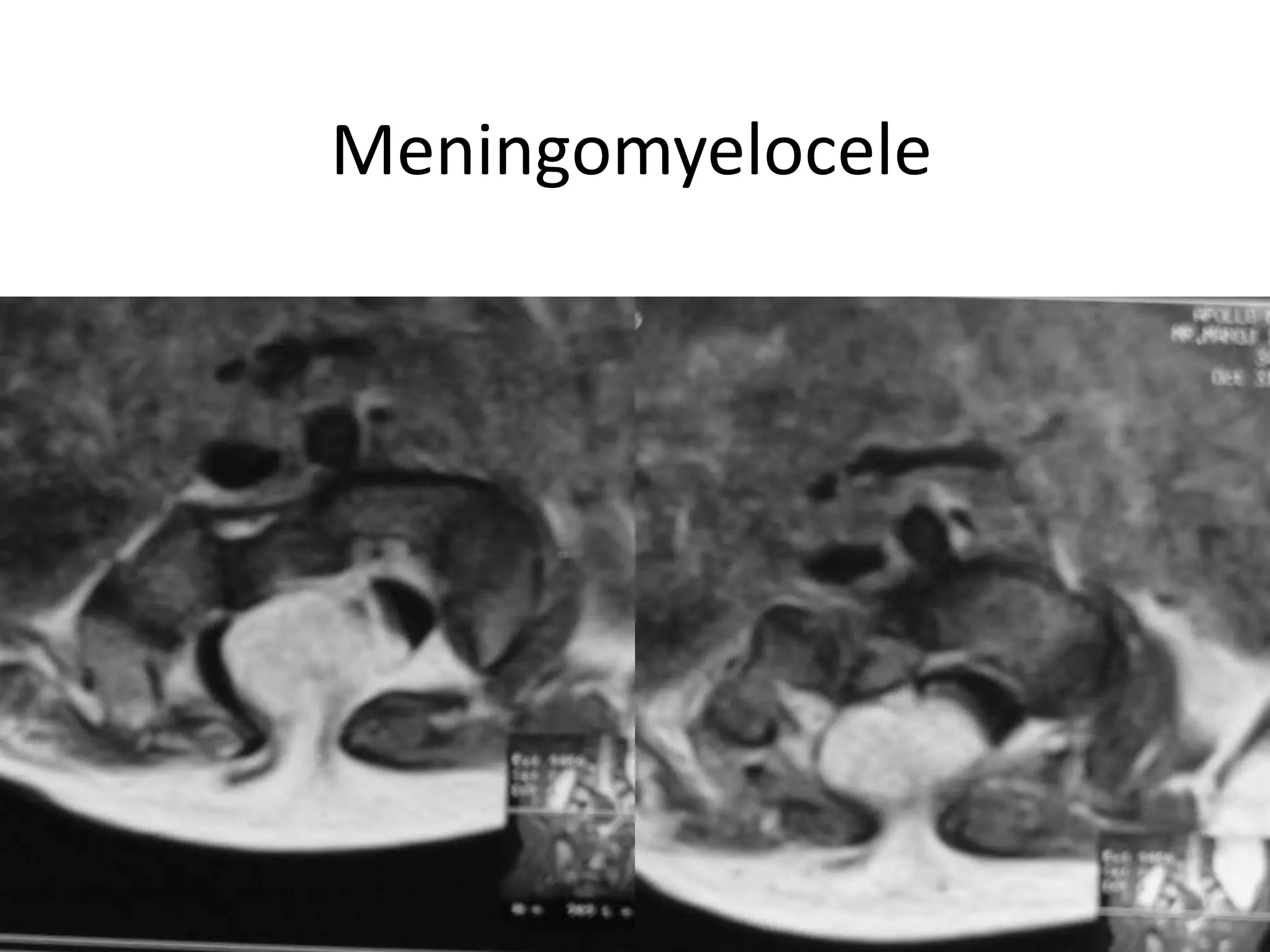 Meningomyelocele