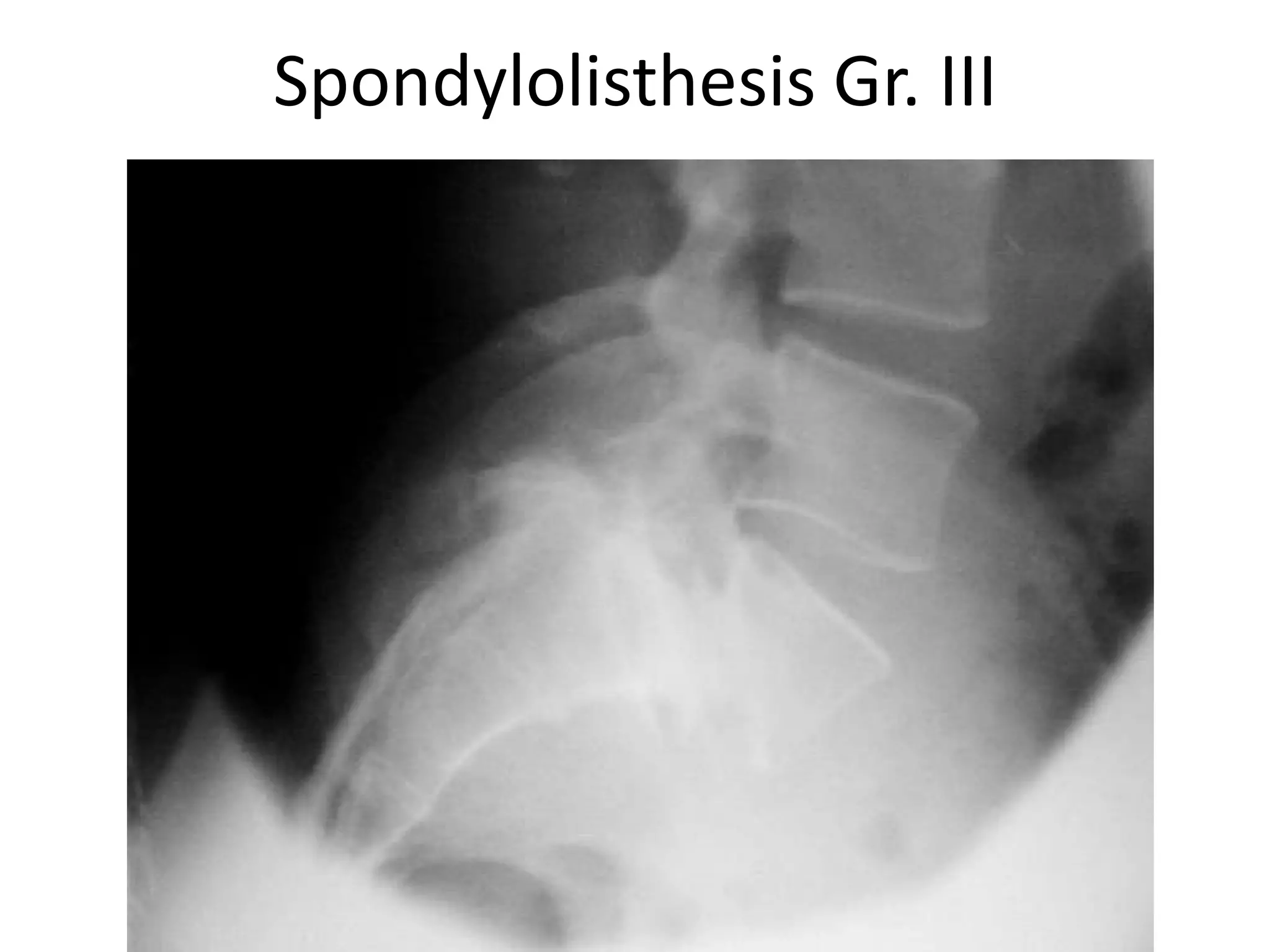 Spondylolisthesis Gr. III