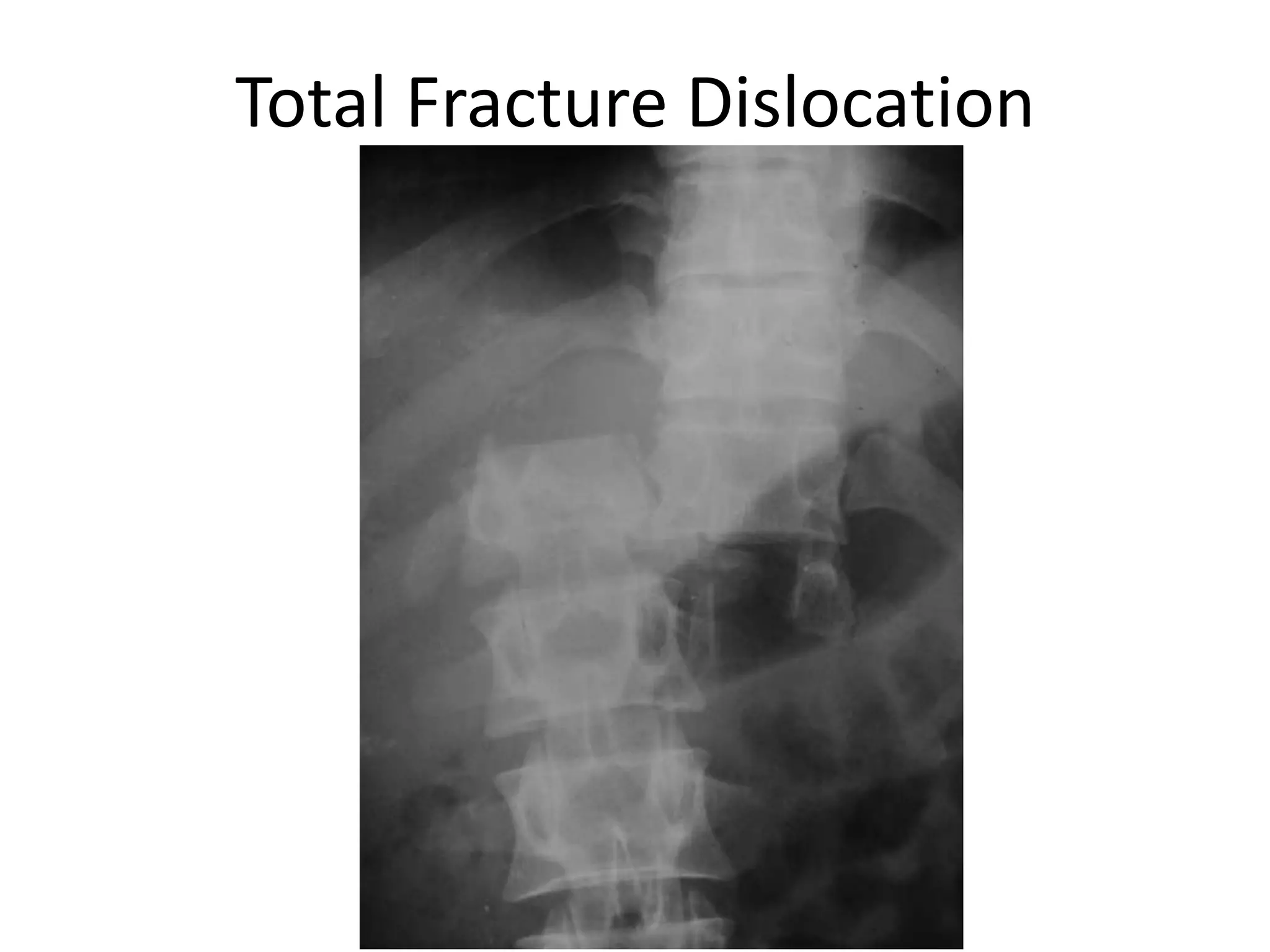 Total Fracture Dislocation