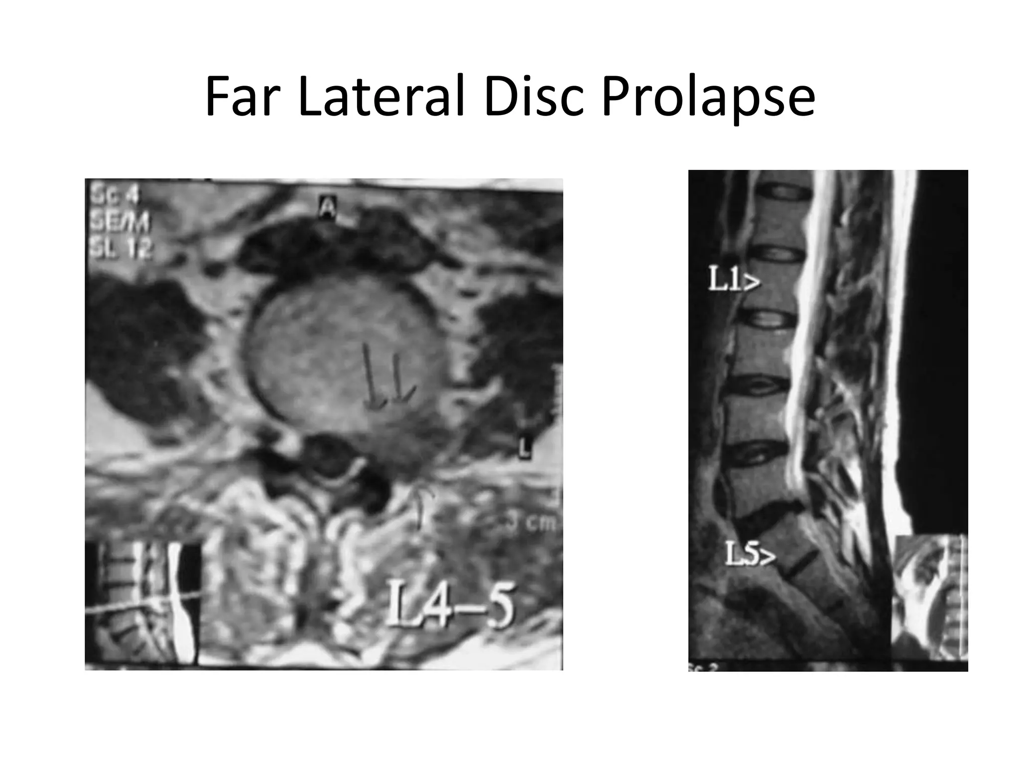Far Lateral Disc Prolapse