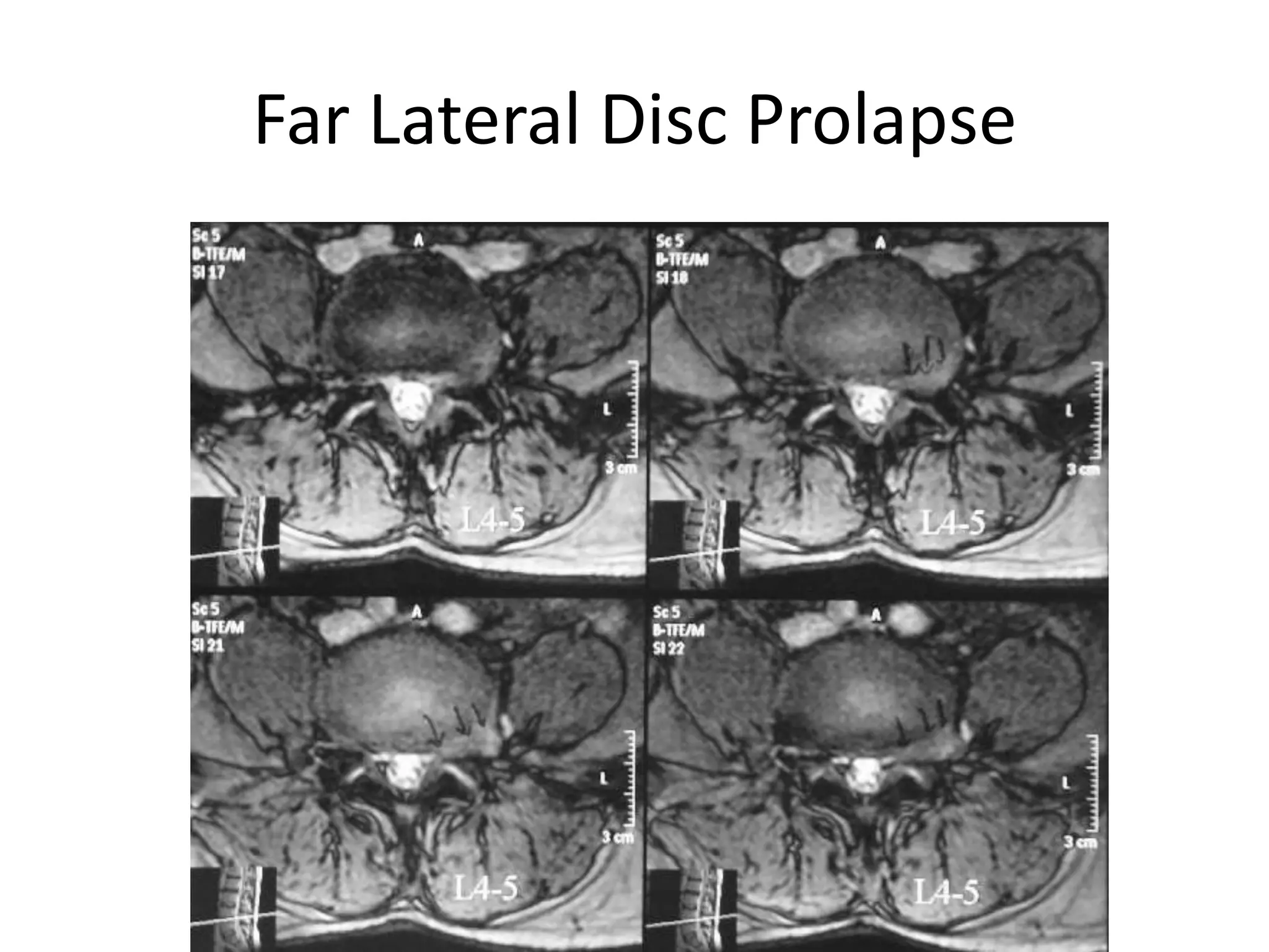 Far Lateral Disc Prolapse