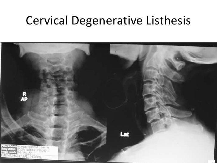 Cervical spondylolisthesis symptoms image