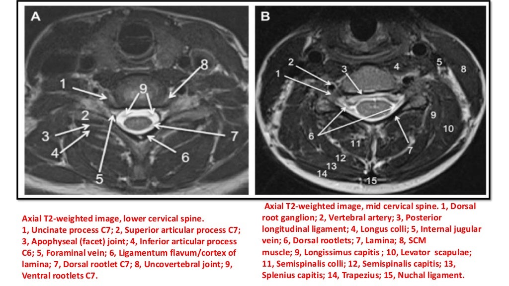 MRI SPINE ANATOMY