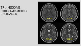 Mri spin echo pulse sequences its variations and | PPTX