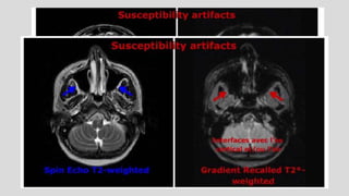 Mri spin echo pulse sequences its variations and | PPTX