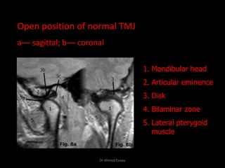 Tmj Radiograph Positioning MRI TMJ temporo mandibular jiont Dr Ahmed Esawy | PDF