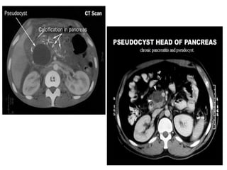 Mri viem tuy cap và bien chung. MRI for acute Pancreatitis