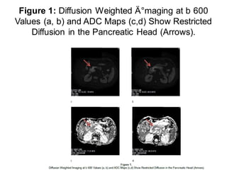 Mri viem tuy cap và bien chung. MRI for acute Pancreatitis
