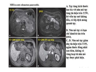 Viêm tuỵ cấp thể phù kẽ mức
độ nhẹ ( Mild acute interstitial
edematous pancreatitis): Ảnh
T2 nhanh (Haste), ảnh T1 3D
GRE ...