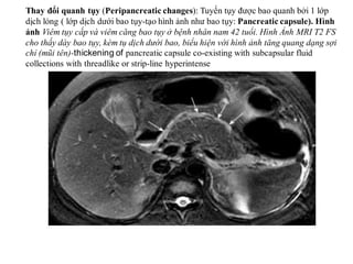 • Tăng áp lực tĩnh mạch cửa ở vùng
tụy (Pancreaticregional portal
hypertension)ở bệnh nhân nam 36
tuổi với tiền sử viêm tụ...