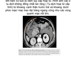 Nữ 32 tuổi viêm tuỵ cấp hoại tử đã được chụp cả CT và MRI trong khoảng 3 ngày sau
khi khởi phát triệu chứng. TRên CT (A,C)...