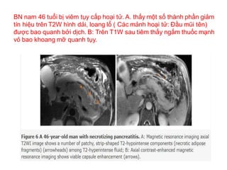 Một phụ nữ 39 tuổi bị hoại tử quanh tụy (peripancreatic necrosis) đã được chụp CT và
MRI trong vòng 7-10 ngày sau khi khởi...