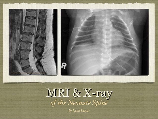 MRI and XRay of the Neonate Spine