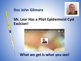 Mr. Lear Has a Pilot Epidermoid Cyst
Excision!
What we get is what you see!
Doc John Gilmore
 