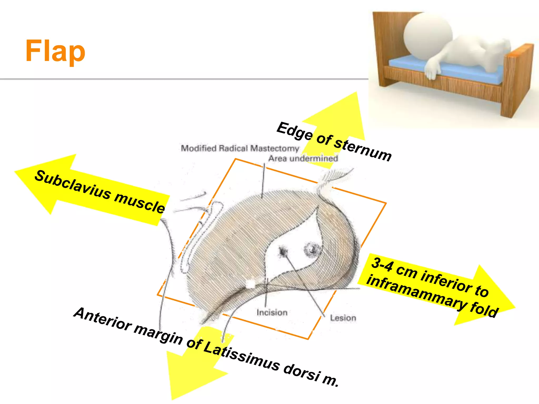 Modified Radical Masectomy PPT
