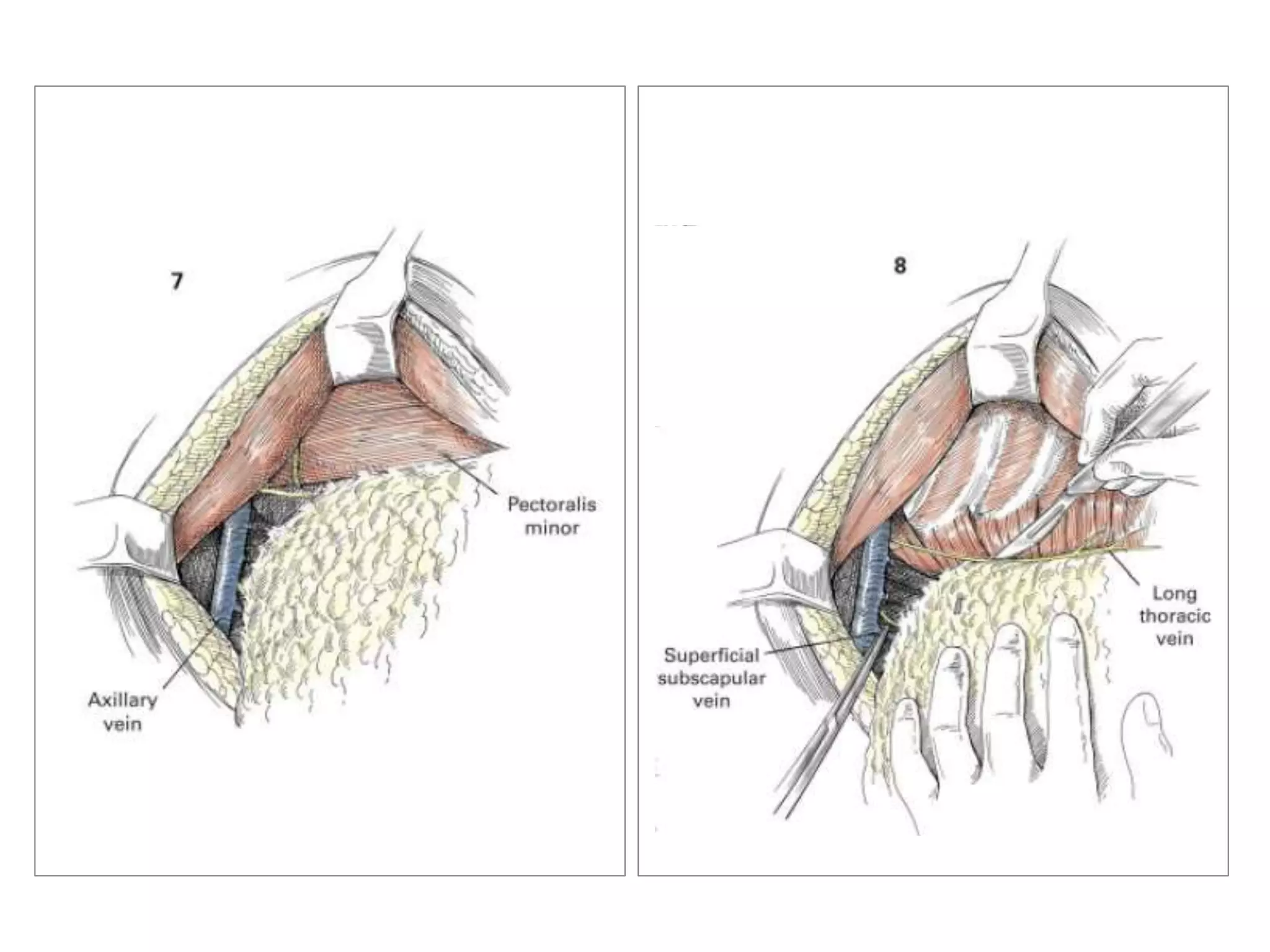 Modified Radical Masectomy | PPT