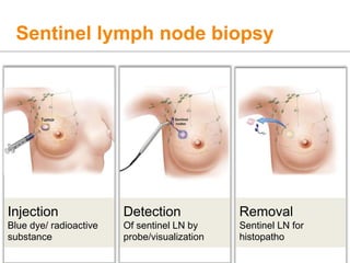 Sentinel lymph node biopsy
Injection
Blue dye/ radioactive
substance
Detection
Of sentinel LN by
probe/visualization
Removal
Sentinel LN for
histopatho
 