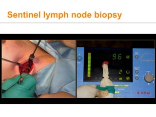Sentinel lymph node biopsy
 