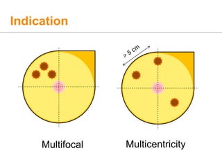 Indication
MulticentricityMultifocal
 