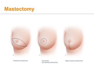 Mastectomy
 