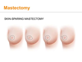 Mastectomy
SKIN-SPARING MASTECTOMY
 