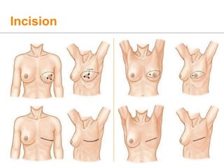 Incision
 