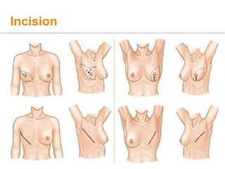 Incision
 