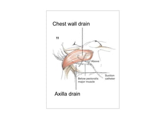 Chest wall drain
Axilla drain
 