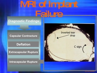 Mr Mammography New | PPT