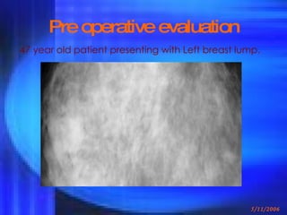 Pre operative evaluation 47 year old patient presenting with Left breast lump. 