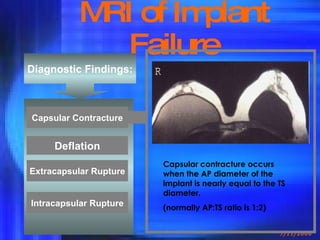 MRI of Implant Failure Diagnostic Findings: Deflation Capsular Contracture Extracapsular Rupture Intracapsular Rupture Capsular contracture occurs when the AP diameter of the implant is nearly equal to the TS diameter.  (normally AP:TS ratio is 1:2) 