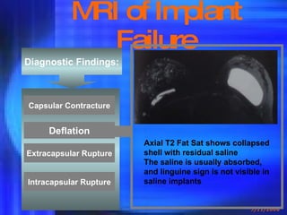 MRI of Implant Failure Diagnostic Findings: Deflation Capsular Contracture Extracapsular Rupture Intracapsular Rupture Axial T2 Fat Sat shows collapsed shell with residual saline The saline is usually absorbed, and linguine sign is not visible in saline implants 