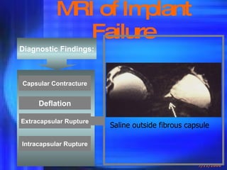 MRI of Implant Failure Diagnostic Findings: Deflation Capsular Contracture Extracapsular Rupture Intracapsular Rupture Saline outside fibrous capsule 