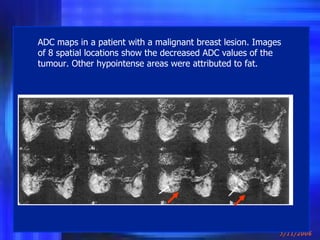 ADC maps in a patient with a malignant breast lesion. Images of 8 spatial locations show the decreased ADC values of the tumour. Other hypointense areas were attributed to fat. 