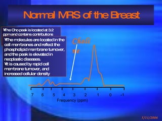 Normal MRS of the Breast 7  6  5  4  3  2  1  0  -1  Frequency (ppm) Choline  ,[object Object],[object Object],[object Object]