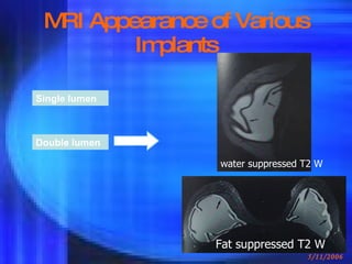 MRI Appearance of Various Implants Single lumen Double lumen Fat suppressed T2 W water suppressed T2 W 