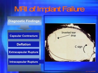 MRI of Implant Failure Diagnostic Findings: Deflation Capsular Contracture Extracapsular Rupture Intracapsular Rupture Inverted tear drop C sign 