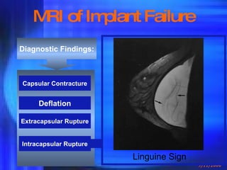 MRI of Implant Failure Diagnostic Findings: Deflation Capsular Contracture Extracapsular Rupture Intracapsular Rupture Linguine Sign 