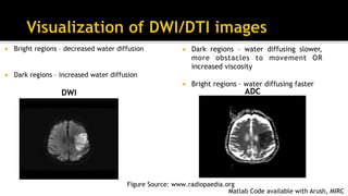¡  Dark regions – water diffusing slower,
more obstacles to movement OR
increased viscosity
¡  Bright regions – water diffusing faster
DWI
¡  Bright regions – decreased water diffusion
¡  Dark regions – increased water diffusion
Figure Source: www.radiopaedia.org
ADC
Matlab Code available with Arush, MIRC
 