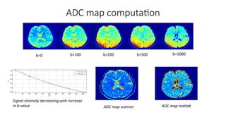 ADC map computa'on
b=0	 b=100	 b=200	 b=500	 b=1000	
Signal	intensity	decreasing	with	increase	
in	b-value	 ADC	map	scanner	 ADC	map	matlab	
 