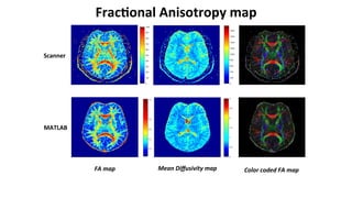 FA	map	 Mean	Diﬀusivity	map	
Scanner	
MATLAB	
Color	coded	FA	map	
Frac-onal	Anisotropy	map	
 