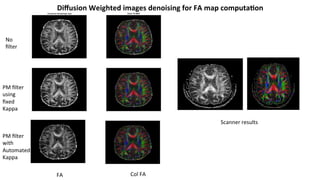 FA	 Col	FA	
No	
ﬁlter	
PM	ﬁlter	
using	
ﬁxed	
Kappa	
PM	ﬁlter	
with	
Automated	
Kappa	
Scanner	results	
Diﬀusion	Weighted	images	denoising	for	FA	map	computa-on	
 