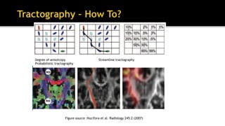 Degree of anisotropy Streamline tractography
Probabilistic tractography
Figure source :Nucifora et al. Radiology 245:2 (2007)
 