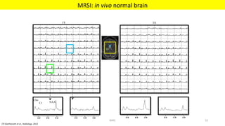 [7]	Geethanath	et	al.,	Radiology.	2012	
MRSI:	in	vivo	normal	brain	
1X
NAACr
Cho
5X
MIRC	 52	
 