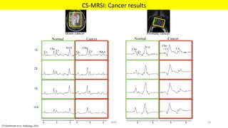 [7]	Geethanath	et	al.,	Radiology.	2012	
Brain cancer
1X
2X
5X
10X
Prostate cancer
Normal CancerNormal Cancer
NAACr
ChoNAA
Cr
Cho
Cr2 Cr2 Cr
Cho
Cit
Cit
Cho
+ Cr
CS-MRSI:	Cancer	results	
MIRC	 53	
 