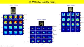 Brain - cancer
Prostate - cancer
Brain - Normal
Brain - Normal
 Brain - cancer
Prostate - cancer
CS-MRSI:	Metabolite	maps	
MIRC	 54	
[7]	Geethanath	et	al.,	Radiology.	2012	
 