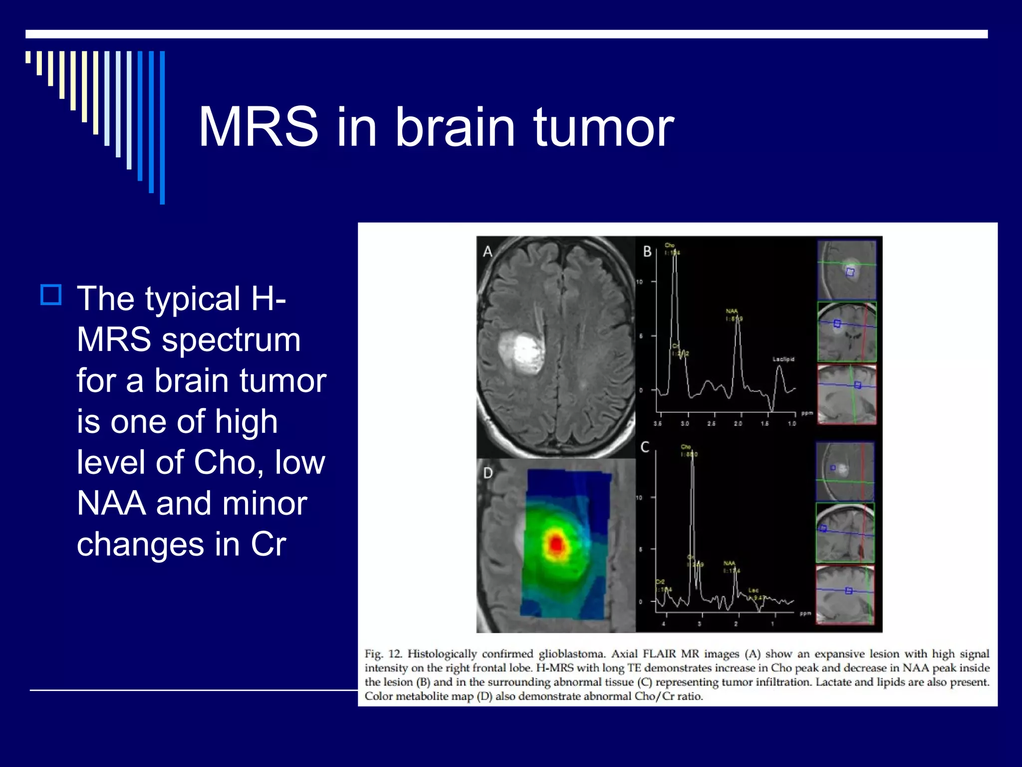 Mrs. Brain Example MRS | PPT