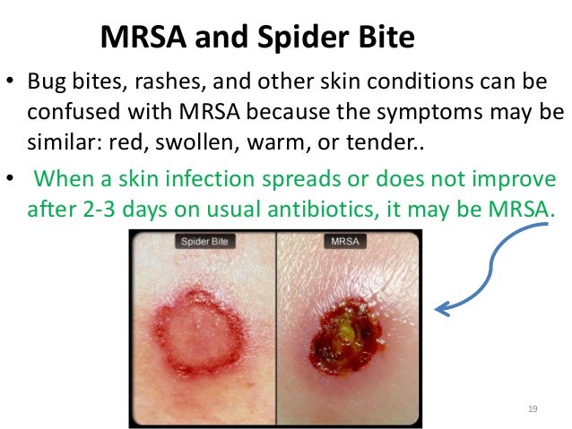 Essay on mrsa infection