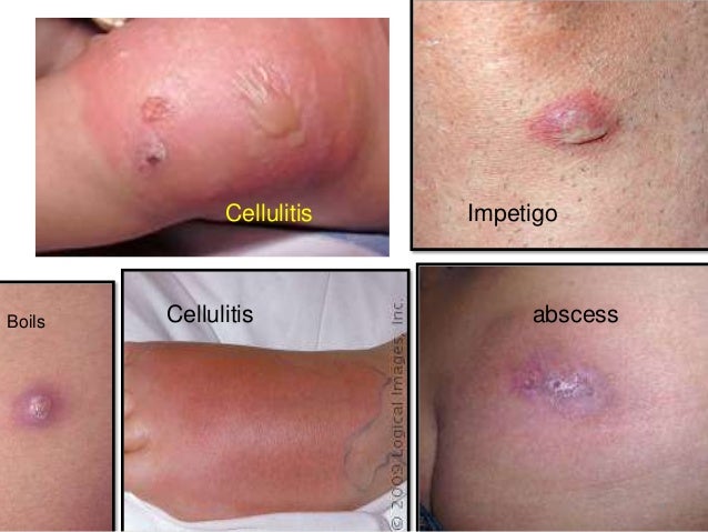 Mrsa Cellulitis