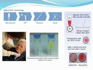 Fluorescent probe before (left) and after (right) 
addition of S. aureus 
 